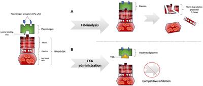 Tranexamic acid: a narrative review of its current role in perioperative medicine and acute medical bleeding